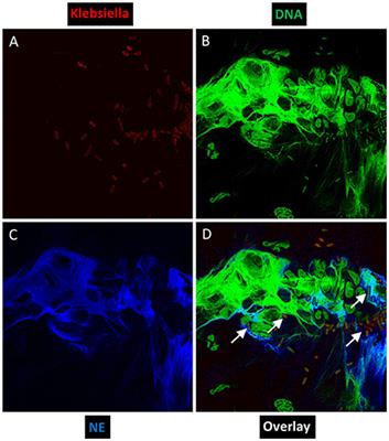 Comparison of Diabetic and Non-diabetic Human Leukocytic Responses to Different Capsule Types of Klebsiella pneumoniae Responsible for Causing Pyogenic Liver Abscess